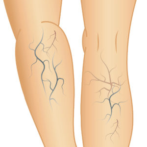 下肢静脈瘤とは 静岡静脈瘤クリニック