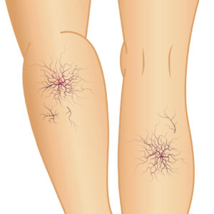 下肢静脈瘤とは 静岡静脈瘤クリニック