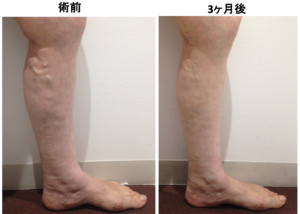 ふくらはぎの下肢静脈瘤の術前、術後の比較。ボコボコした血管が消失し、むくみが改善されている。