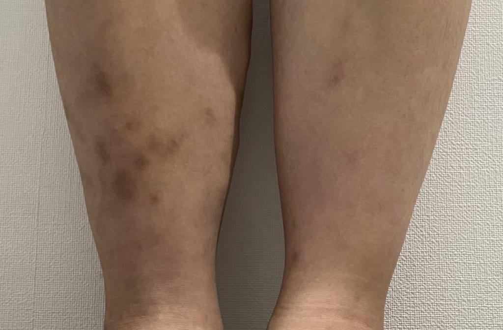 足の だるさ と静脈瘤 静岡静脈瘤クリニック