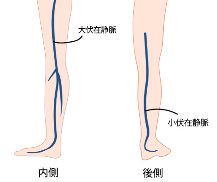 下肢静脈瘤とは 静岡静脈瘤クリニック
