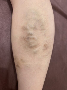 ふくらはぎの下肢静脈瘤。すねからふくらはぎにかけて血管がボコボコと浮き出ており、同じ部位に皮膚の湿疹が色素沈着を起こして茶色くなっている。