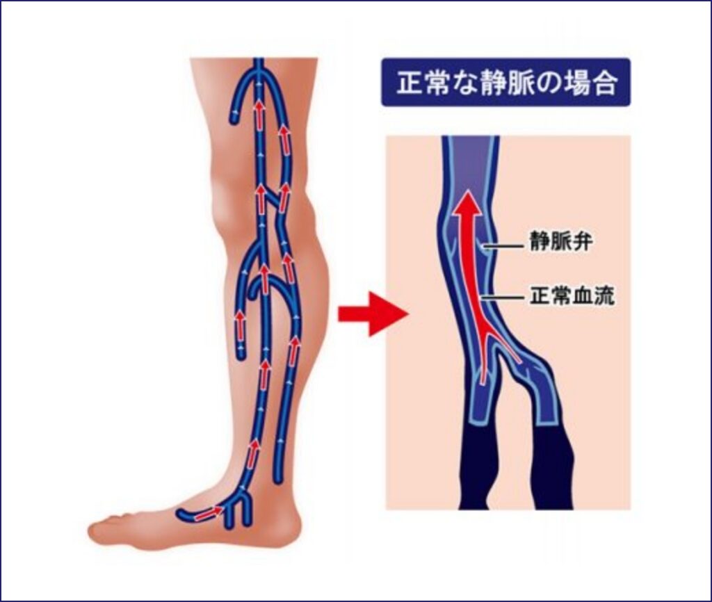 下肢静脈瘤とは 静岡静脈瘤クリニック