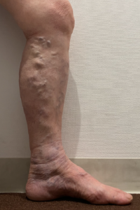 ふくらはぎの下肢静脈瘤。すねからふくらはぎにかけて血管がボコボコと浮き出ており、くるぶしの皮膚の色が悪くなっている。血栓の危険性もあり。