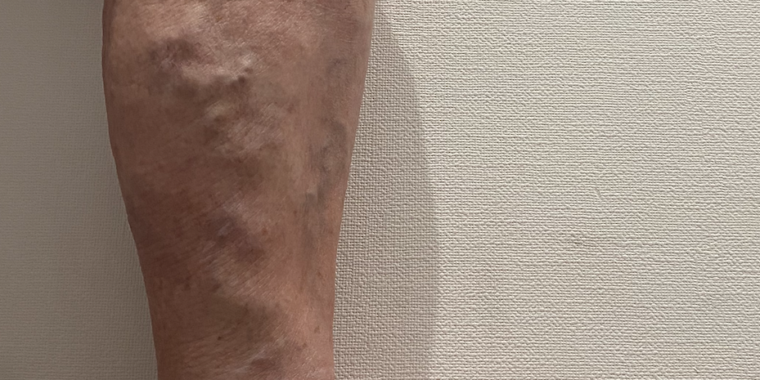 ふくらはぎの下肢静脈瘤。すねからふくらはぎにかけて血管がボコボコと浮き出ており、くるぶしの皮膚の色が悪くなっている。血栓の危険性もあり。