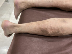 ふくらはぎに血管がボコボコと浮いた下肢静脈瘤に皮膚炎を合併し、色素沈着の状態